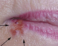 аллергия на татуаж губ